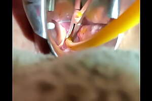 Inserting Foley into cervix