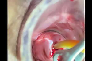 Crying as 18 Fr catheter penetrates cervix